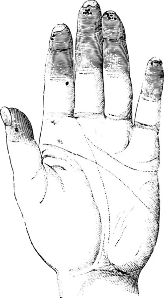 硬化症或硬化症左手 手掌表面 老式雕刻图解 Labarthe博士的 普通医学词典 1885年 — 图库矢量图片