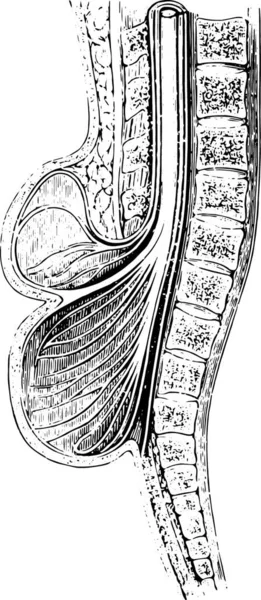 Coupe Antérieure Colonne Vertébrale Pratiquée Sur Une Spina Bifida Illustration — Image vectorielle