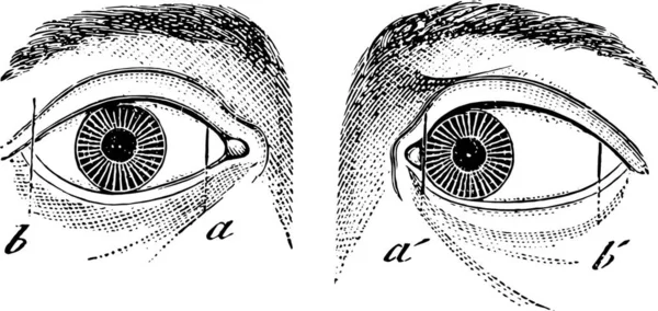 左目のエストロピア ヴィンテージの刻まれたイラスト ラブラドール博士の医学辞典 1885 — ストックベクタ