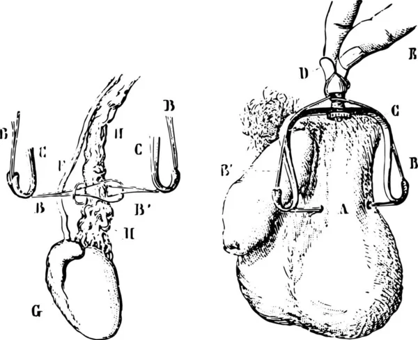 법랑질 Varicocele Ligation 빈티지 라브라 1885 박사의 — 스톡 벡터
