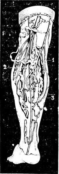 腿上的静脉曲张 古老的雕刻图解 Labarthe博士的 普通医学词典 1885年 — 图库矢量图片