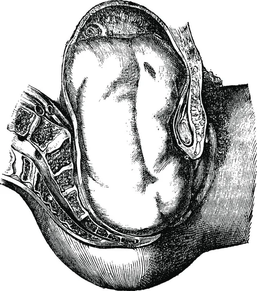 お尻の彼らの排除 ヴィンテージの図は刻まれています マガシンドス Pittoresque 1875 — ストックベクタ