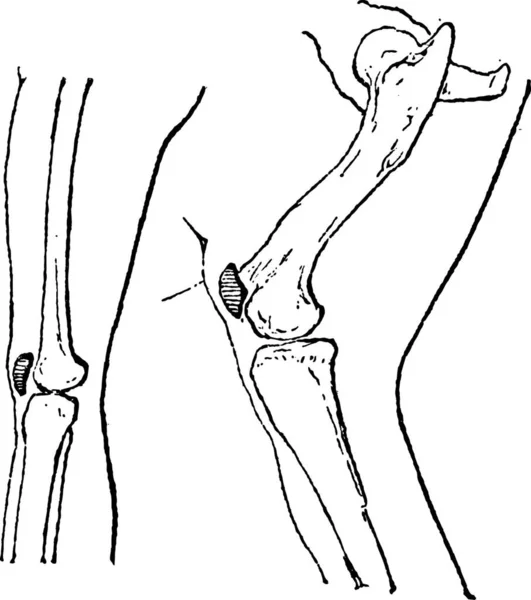 Knieschijf Patella Kneepan Vintage Gegraveerd Illustratie Woordenboek Van Woorden Dingen — Stockvector