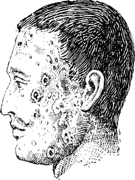 人間の顔の白い背景で隔離膿痂疹に感染している古い刻まれたイラストです 言葉と事物 Larive フルーリの辞書ですか 1895 — ストックベクタ
