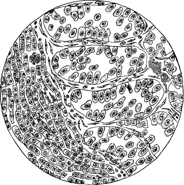 Ausschnitt Des Leberkarzinoms Gravierte Illustration — Stockvektor