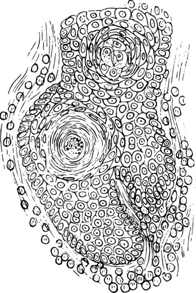 Skuamöz Epithelioma Vintage Oyulmuş Illüstrasyon Bölümü — Stok Vektör