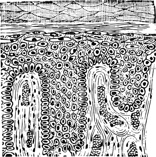 鳞状上皮瘤 复古雕刻插图 — 图库矢量图片