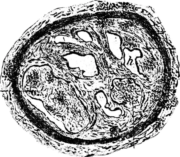 Sección Transversal Vaso Sanguíneo Trombótico Que Organización Canalización Del Trombo — Archivo Imágenes Vectoriales