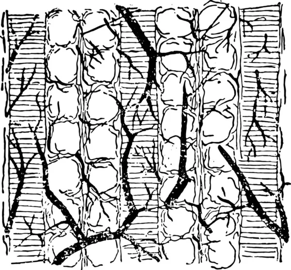 Pseudohypertrophic 肌肉麻痹 肌肉脂肪浸润 复古雕刻插图 — 图库矢量图片