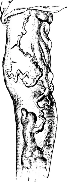 脚の静脈瘤 ヴィンテージ刻まれた図 — ストックベクタ