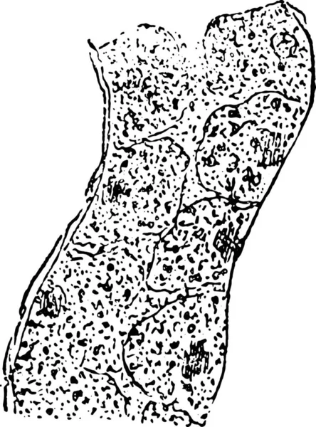 曇り腎尿細管上皮の腫れ ヴィンテージの刻まれた図 — ストックベクタ
