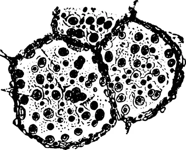 Due Alveoli Una Parte Terzo Polmone Polmonite Catarrale Illustrazione Incisa — Vettoriale Stock