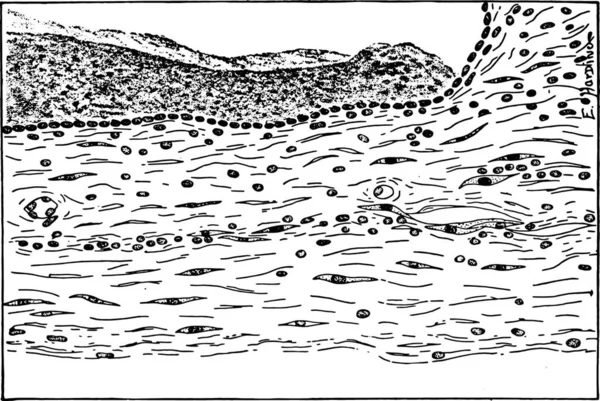 腎臓は 大きな嚢胞の壁の一部の先天性ののう胞疾患ヴィンテージ刻まれた図 — ストックベクタ