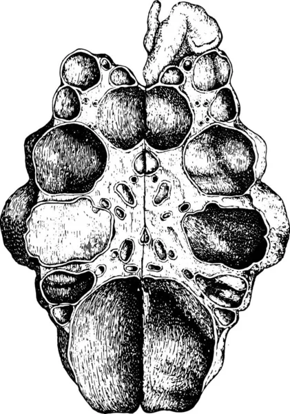 Njure Medfödd Cystisk Sjukdom Som Öppet Vintage Ingraverad Illustration — Stock vektor