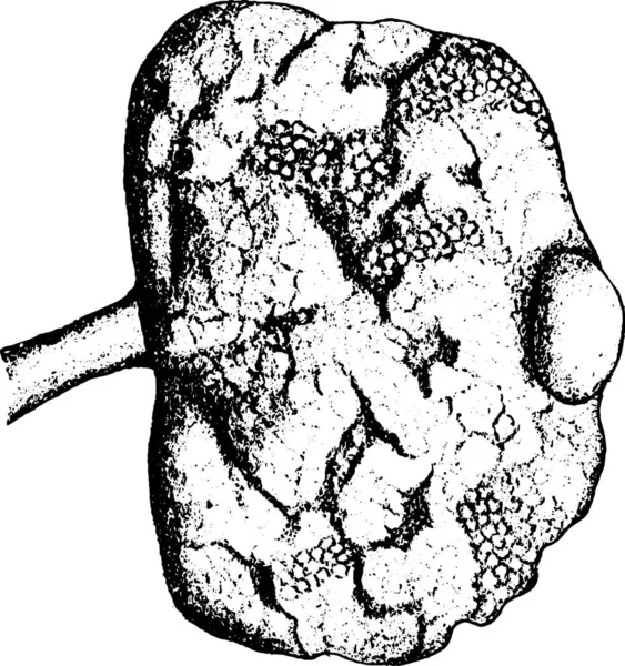 Почка Показывает Прогрессирующий Хронический Интерстициальный Нефрит Винтажные Гравированные Иллюстрации — стоковый вектор