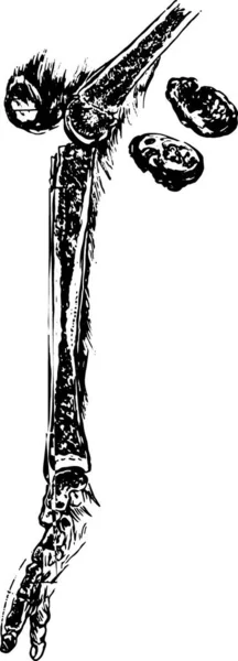 Остеомієліт Участю Великогомілкової Кістки Вінтажні Гравіровані Ілюстрації — стоковий вектор