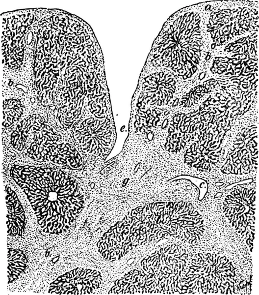 Syphilitische Leberzirrhose Vintage Gravur — Stockvektor