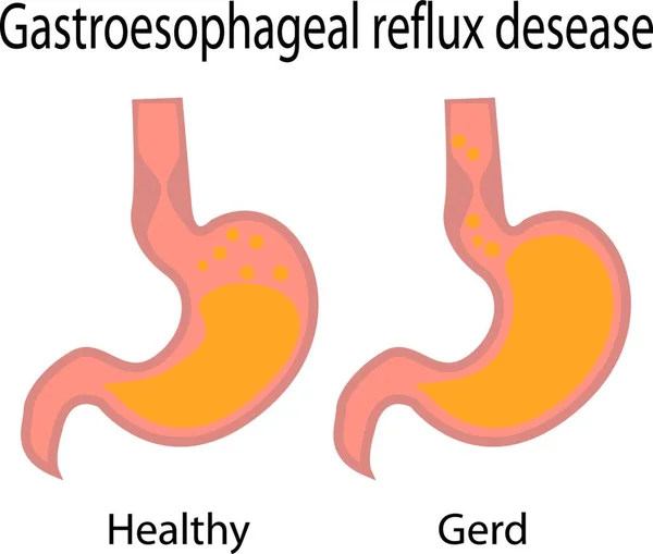Gastroesofageal Refluxsjukdom Friska Och Gerd Mage Vektor Illustration Vit Bakgrund — Stock vektor