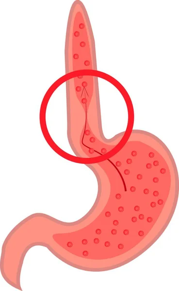 胃食管反流病 白色背景上的格德胃矢量插图 — 图库矢量图片