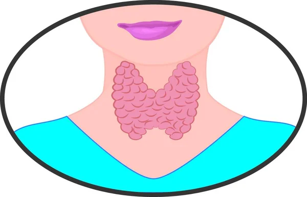 Goitre Thyroïde Élargie Illustration Vectorielle Dysfonctionnement Endocrinien Sur Fond Blanc — Image vectorielle