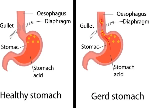 Asam Gastroesofagus Refluks Penyakit Ilustrasi Vektor Perut Yang Sehat Dan - Stok Vektor