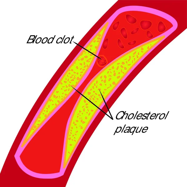 Bloedstolsel Cholesterol Plaque Geblokkeerde Bloedvat Illustratie Een Witte Achtergrond — Stockvector