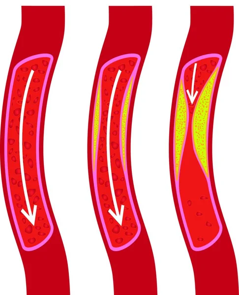 Zdrowe Częściowo Zablokowane Naczynie Krwionośne Zablokowane Naczynie Krwionośne Tabliczka — Wektor stockowy