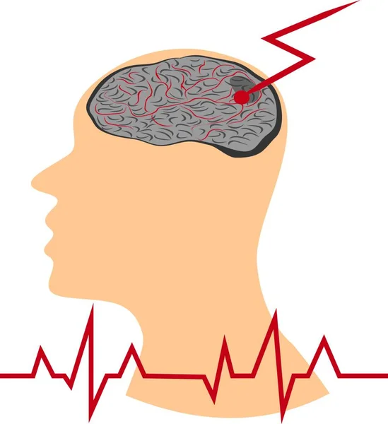 Avc Développe Dans Cerveau Humain Illustration Vecroe — Image vectorielle