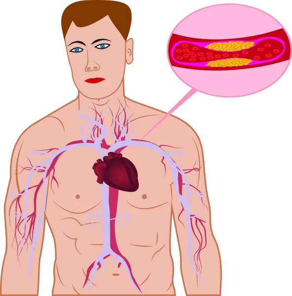 Ilustracja Wektorowa Poziomu Płytki Cholesterolu Naczyniach — Wektor stockowy
