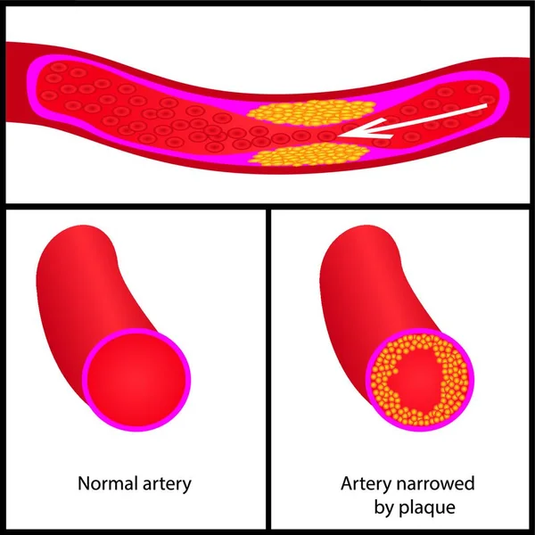 Düzeyleri Kolesterol Plak Damarlarının Illüstrasyon Vektör — Stok Vektör