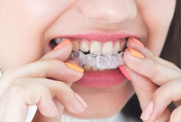 Invisible braces aligner, woman smiling