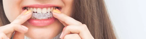 Aligner Aparelho Invisível Mulher Sorrindo — Fotografia de Stock