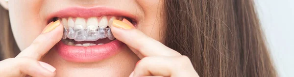 Invisible braces aligner, woman smiling