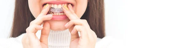 Alineador Frenos Invisible Mujer Sonriendo — Foto de Stock