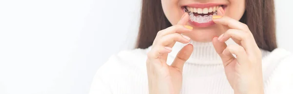 Alineador Frenos Invisible Mujer Sonriendo — Foto de Stock