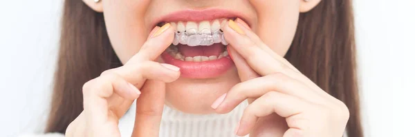 Görünmez Diş Telleri Hizalayıcı Gülümseyen Kadın — Stok fotoğraf