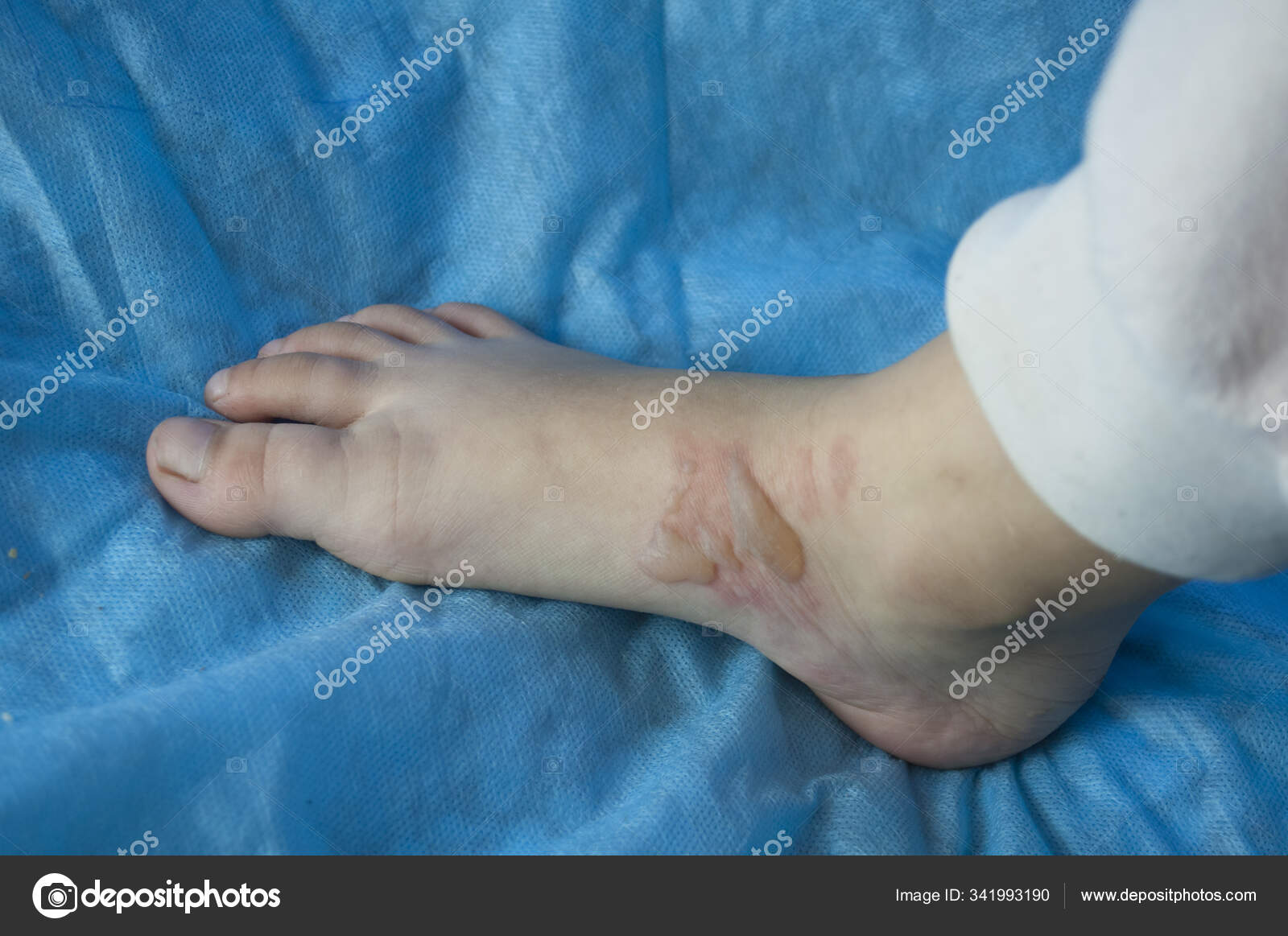 Blisters on a child's foot from scalding Stock Photo by ©ElanHavrilyuk