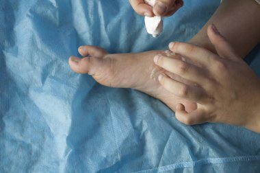 Çocuğun ayağında kaynar su kabarcıkları var.