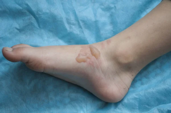 Swelling on the child's foot from scalding — Stock Photo, Image