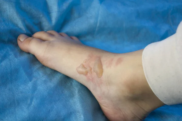 Çocuğun ayağında kaynar su kabarcıkları var.