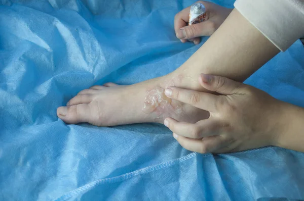 Ampollas en el pie de un niño por escaldar —  Fotos de Stock