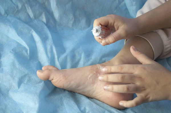 blisters on a child\'s foot from scalding