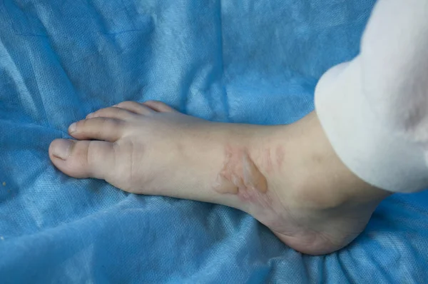 Çocuğun ayağında kaynar su kabarcıkları var.