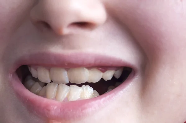 Ağzı açık gülümseyen bir çocuk tasvir ediyor, çarpık dişlerini gösteriyor.