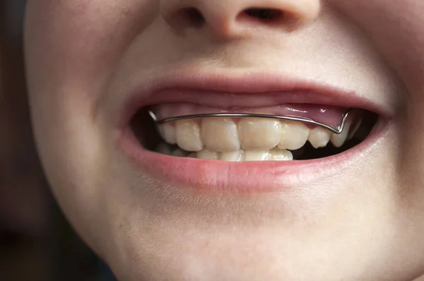 Defects of the jaw, crooked teeth in a child of 9 years, teeth requiring correction of the bite.Bite correction with orthodontic retainers.  Close up