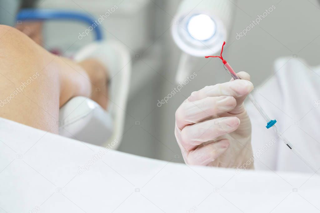 Gynecologist holding an IUD birth control device before using it for patient