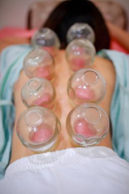 Çin tıp bilimi Cupping 'i kullanarak yapılan bir tedavi yöntemidir. 