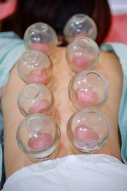Çin tıp bilimi Cupping 'i kullanarak yapılan bir tedavi yöntemidir. 