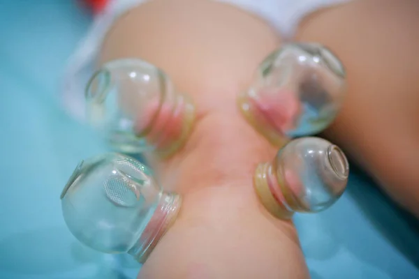 Chinese medicine science is a method of treatment using Cupping