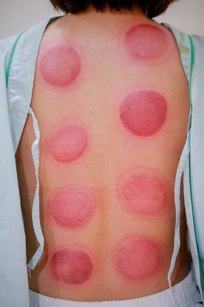 Chinese medicine science is a method of treatment using Cupping